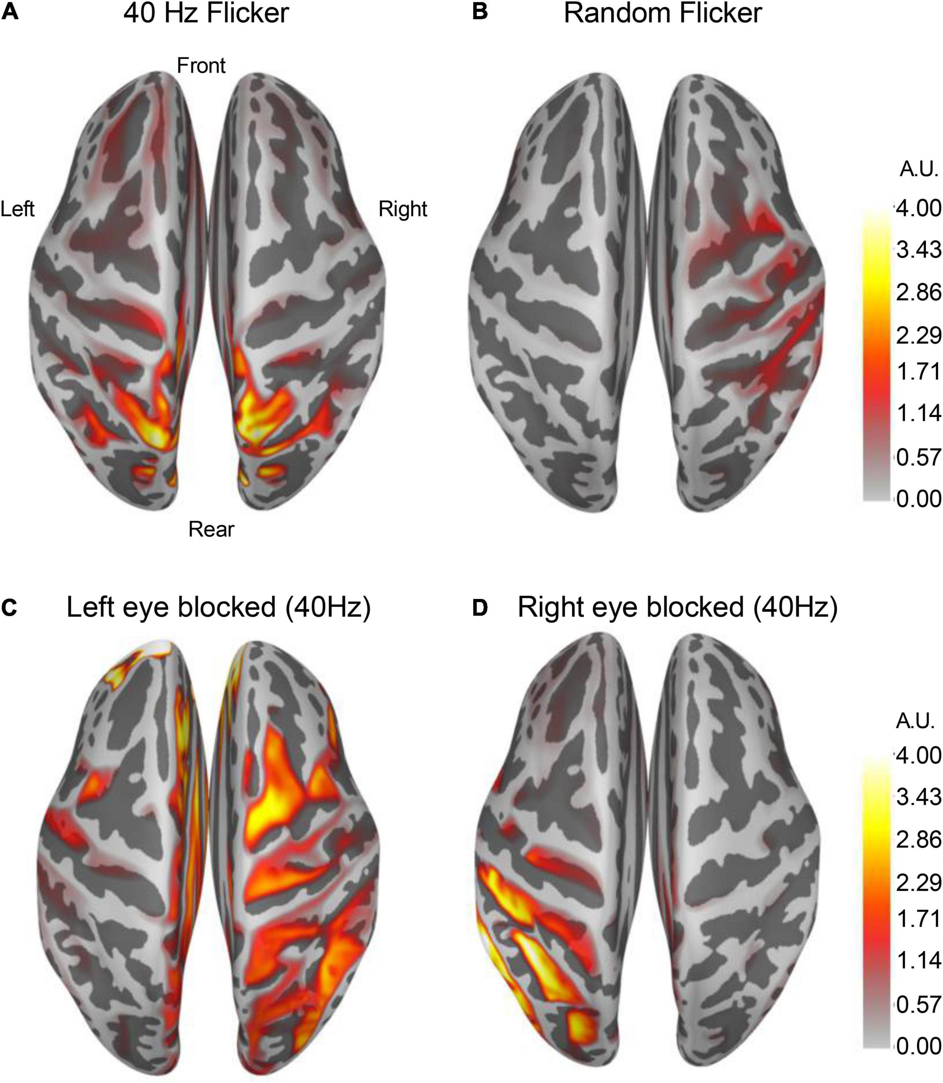 40 Hz light flicker alters human brain EEG microstates and complexity with implications in brain diseases